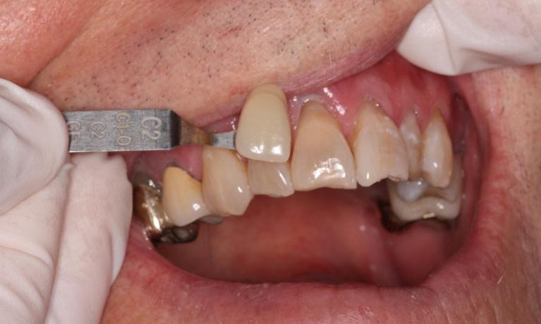 Zoom-Whitening-Really-Makes-a-Difference-After-Image