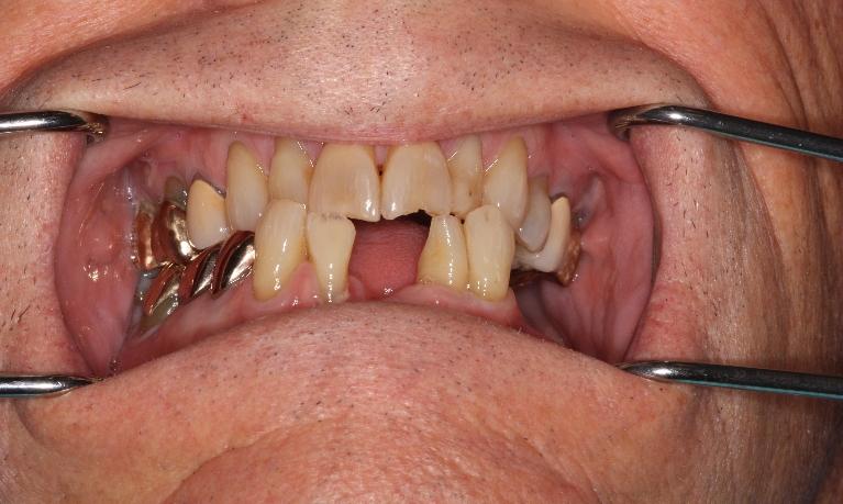 Zoom-Whitening-Really-Makes-a-Difference-Before-Image