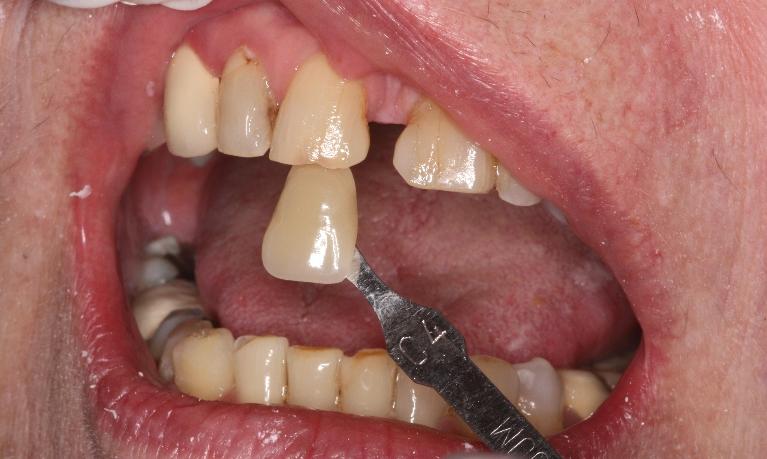 Zoom-Whitening-Before-Image