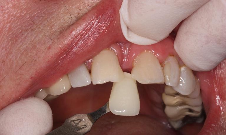 Zoom-Whitening-After-Image